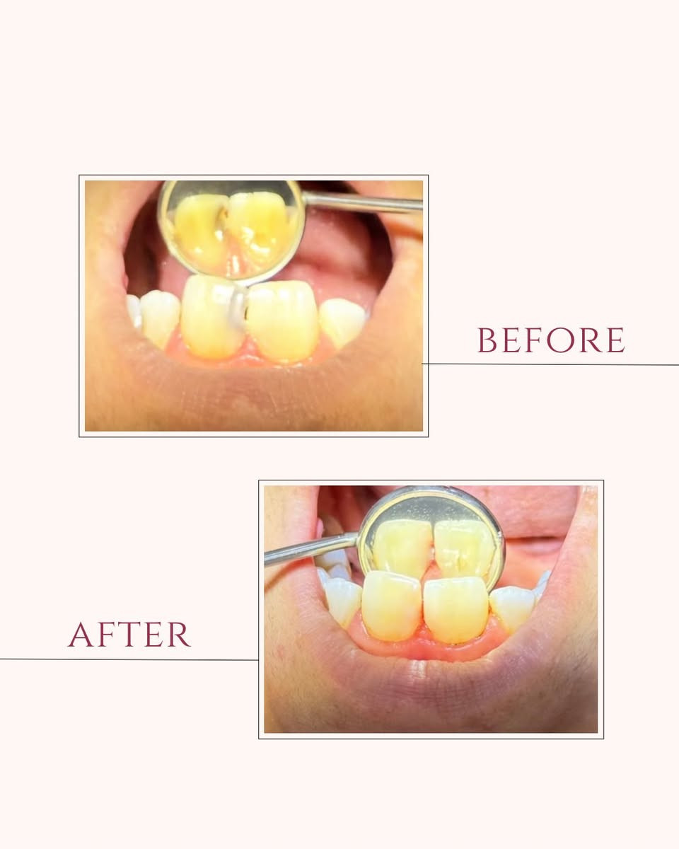 🌙✨ عروض آخر أسبوع من رمضان – مجمع السيف الطبي لطب الأسنان ✨🌙

قبل العيد… اعتنِ بابتسامتك واستفد من عروضنا الخاصة:

🦷 خصومات على حشوات الأسنان  
🦷 خصومات على حشوات الجذور (سحب العصب)  
🦷 خصومات على قلع الأسنان

🎁 عرض خاص: تنظيف أسنان مجاناً مع كل حشوة  
🔎 معاينة مجانية طوال هذا الأسبوع

👨‍⚕️ بإشراف: الدكتور علي سالم جمعة

📍 الموقع: بغداد – الكميرة قرب جامع أبو الزهراء  
🗓 أيام الدوام: السبت – الاثنين – الأربعاء  
📞 للتواصل والاستفسار والحجز: ***********

✨ ابتسامتك تهمنا…
نموذج عن الشغل
