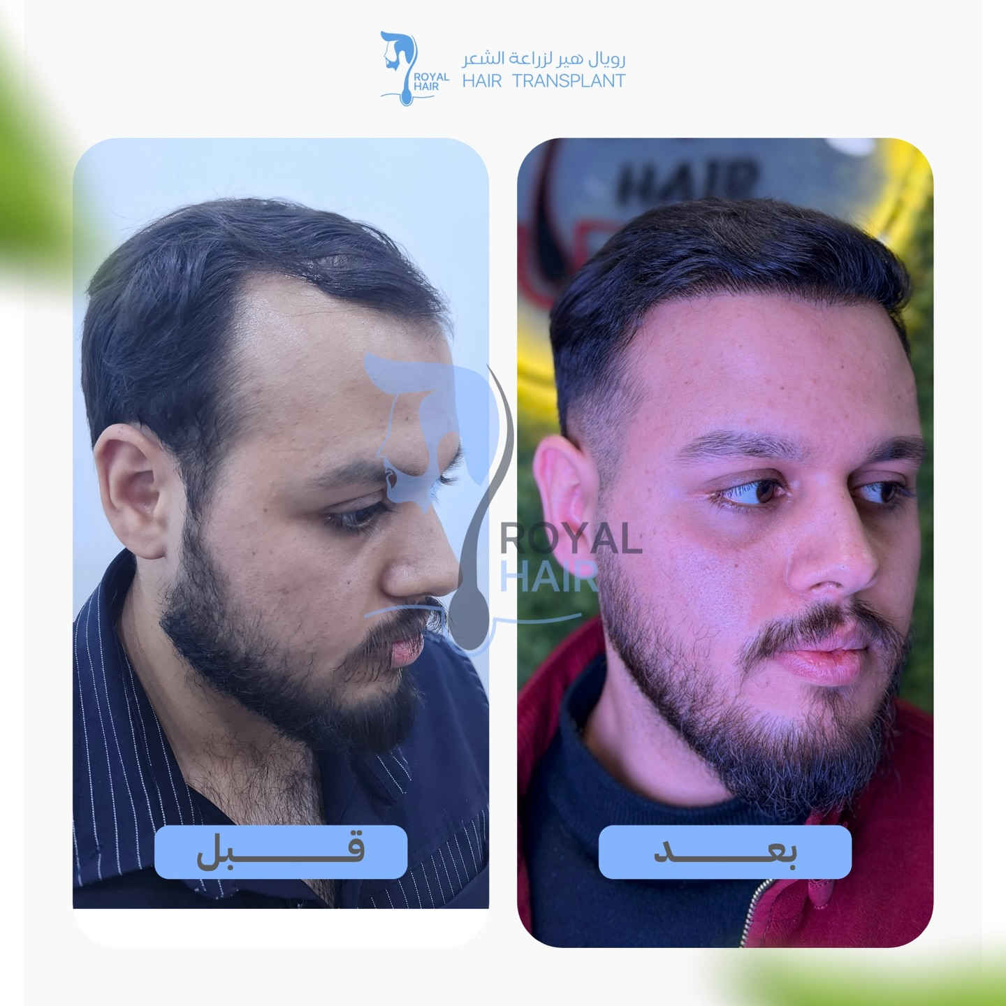 نتيجة 5 أشهر من زراعة الشعر 👌
مو كل عملية زراعة تطلع بهيج كثافة بهالوقت…
الفرق يصنعه نوع البصيلات 🌱،
تغذيتها الصحيحة 🍃،
والعناية الدقيقة بالشعر المزروع بعد العملية.
لما تكون الأسس صحيحة، النتيجة تبين أسرع وبشكل طبيعي ✨
والأجمل؟ القادم أفضل 💯

للحجز والاستفسار مراسلة الصفحة او الاتصال على ***********

العنوان بغداد المنصور شارع الاميرات مجاور ست الشام بناية جود ط٢
