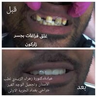 سن زركون • بالجسر • عرض محدود