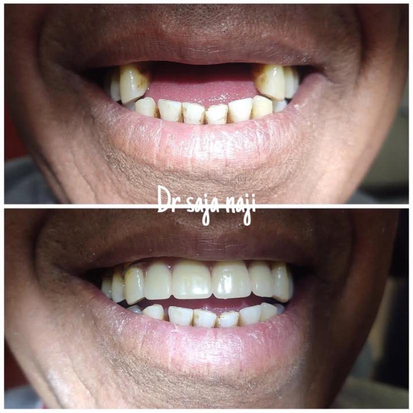 🦷✨ عيادة الدكتورة سجى ناجي

🎉 عرض خاص بمناسبة العيد ولمدة محدودة
فحص الأسنان مجاناً

✔ حشوات تجميلية
✔ علاج عصب
✔ قلع الأسنان
✔ تنظيف وتلميع

💥 عند عمل حشوتين
🎁 تنظيف الأسنان مجاناً

🎊 عروض وخصومات خاصة بالعيد
🔥 لأول 10 مراجعين فقط

📍 الموقع: بابل – الحلة – شارع الأربعين
📞 للحجز والاستفسار: ***********

😊 ابتسامتكم سر ثقتنا
