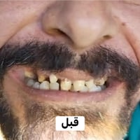 تركيب اسنان • د. موسى الكعبي • مركز سوم