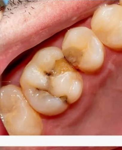 الي عنده مثل هاي التسوسات ومحتاج حشوة او محتاج قلع للاسنان التالفة  العلاج مجاني داخل عيادات جامعة واسط وبإشراف اطباء مختصين تواصلوا وياي عالواتساب ***********
