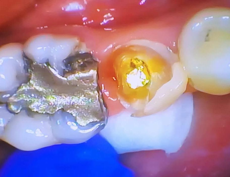 ترميم وبناء سن بحشوة زاركون يابانية تجميلية مع وتد
طبيب الاسنان الاختصاص د.عمار عباس
ماجستير تقويم وتجميل الاسنان M.S.c ortho
بكلوريوس طب وجراحة الفم والأسنان B.D.S
بغداد الشعب شارع عدن قرب  مركز شرطة الشعب  مدخل سوق شلال عمارة باريس الطابق الاول دوام العيادة جميع ايام الاسبوع ما عدا الجمعة عطلة من ٤ ل ٨  بدون حجز مسبق الدخول حسب اسبقية الحضور للعيادة الفحص والمعاينة مجاني للاستفسار ***********
