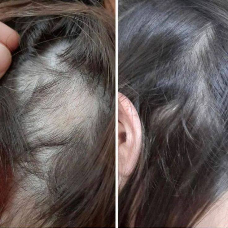 زيت الحيّة 🐍✨
إذا تعبتي من التساقط والتقصّف وبحثتي عن حل فعّال… زيت الحيّة هو سر الشعر الكثيف والطويل! 🌿
تركيبته الغنية تغذّي فروة الرأس بعمق، تنشّط البصيلات، وتساعد على تقوية الشعر من الجذور للأطراف.
يمنحك نعومة حريرية ولمعان صحي واضح من أول استعمال، ومع الاستمرار تلاحظين فرق بالكثافة والطول ✨
مناسب لكل أنواع الشعر، ويقلل الهيشان ويعالج الجفاف حتى يرجّع لشعرك حيويته الطبيعية.
دلّلي شعرك بعناية يستاهلها وخليه يلفت الأنظار بجماله وقوته 💚

#توصيل_كافة_المحافظات


**إذا كنت صاحب هذا الإعلان وتريد حذفه لأي سبب، رجاءا أرسل رسالة إلى الدعم الفني**