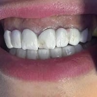 تركيبات زيركون • تجميل أسنان • عيادة البتول