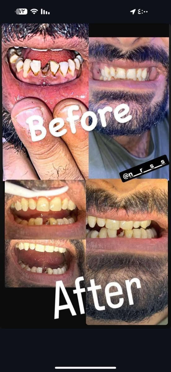 🔵🔵 عيادات النخبة 🔵🔵
د. نور صبيح صالح متمرّس في طب الأسنان وخبرة اكثر من سنتين في المجمعات الطبية (مجمع السلام الطبي و مجمع الواعظ الطبي) 

🔴حشوات الاسنان الضوئية

🔴تعويض الأسنان المفقودة

🔴قلع الأسنان التالفة والجذور

🔴تنظيف الأسنان من التكلسات والتصبغات

🔴معاينة وعلاج امراض والتهابات الفم (اللثة واللسان)

🔴تقويم للاطفال

🔴علاج اسنان الاطفال

 (تنظيف - حشوات - جلسات حماية من التسوس - قلع)

المعاينة والعلاج باحدث الاجهزة والمواد وخصيصآ قسم الحشوات براندات عالمية مثل ماركة GC و ماركة 3M
وموجودة دكتورة اسنان للعوائل المحافظة

العنوان : المنصور مقابل مستشفى الهلال الاحمر

التواصل والإستفسار :

***********
