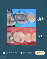 حشوة تجميلية • عيادة اسنان • قضاء عفك
