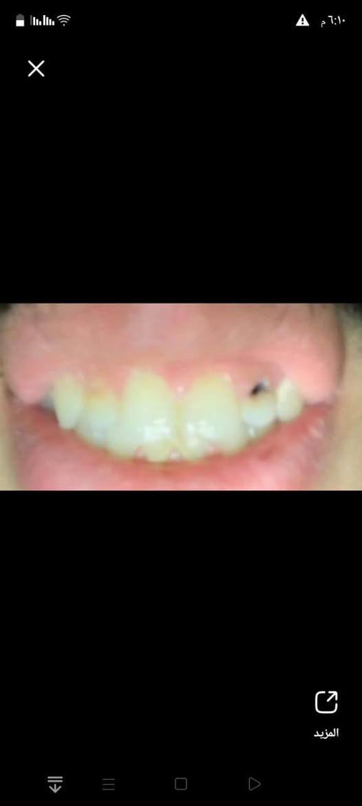 مجانا مجانا بالكامل
نقدم لكم الخدمات التالية بشكل مجاني بالكامل :

١- فحص شامل للفم والأسنان .
٢-تنظيف الأسنان وإزالة التكلسات والتصبغات .
٣- حشوات ضوئية وتجميلية .
٤- قلع الأسنان التالفة والجذور المتبقية .
٥- تعويض الأسنان المفقودة باطقم جزئية متحركة وكاملة. 

العنوان:الدورة الميكانيك نهاية شارع ٦٠ عيادات جامعة الهادي 
للحجز والاستفسار الاتصال او الواتساب ***********
