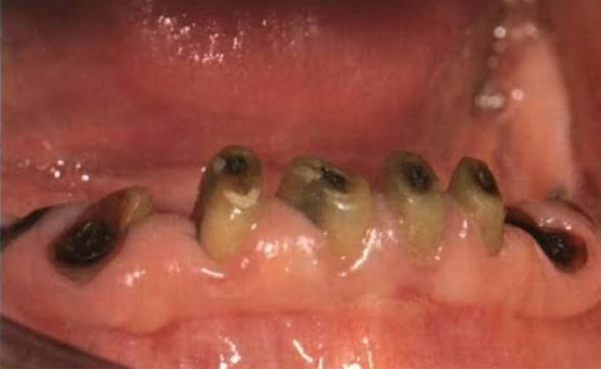 قلع الاسنان التالفه او الجذور ((مجاناً)) تحت اشارف اطباء اختصاص
• دكتورة ملك زياد - للتواصل واتساب ***********
📍العنوان - جامعة الفراهيدي / نزلة جسر الجادرية
