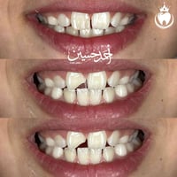 ترميم سن طفل • حشوات تجميلية • المجمع الطبي الحديث