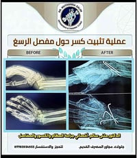 تثبيت كسر • رسغ • تداخل جراحي محدود