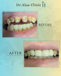 ✨ قوة الجاذبية تبدأ من ابتسامتك!  لا تخلّي سن مفقود يوقف ثقتك، مع جسر ...