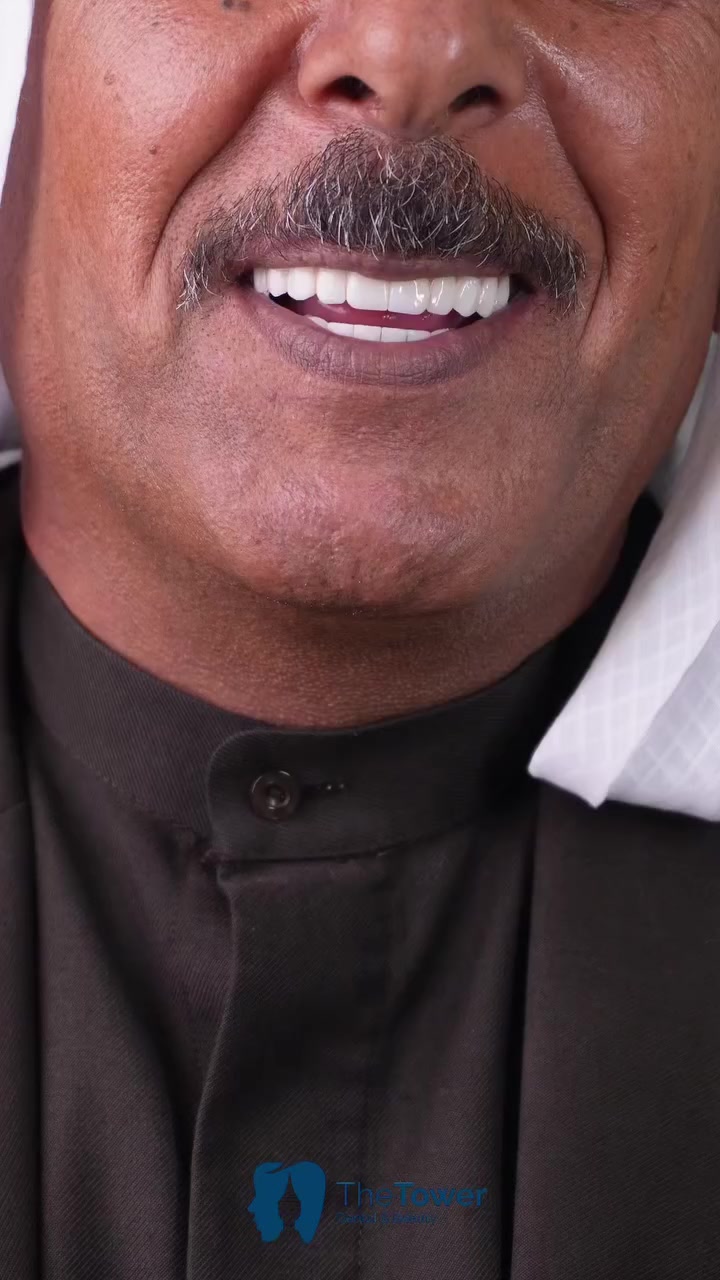 راي المراجع بعد عملية زراعة الاسنان✨

الابتسامة صارت غير شكل 😎

اعادة تأهيل الابتسامة بزراعة الفك العلوي والسفلي بالكامل 

الدكتور سيف العاني

ذا تاور the tower 
خيارك الاول للاهتمام بصحة اسنانك
-
-
-
-
————————————————-
📍: بغداد - اليرموك - مقابل برج بغداد - بالقرب من التفاح الأخضر - مجاور مطعم نوح.
☎️:
0773 349 9555
0786 649 9555⁩
