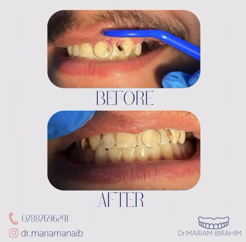 السلا عليكم …
الي محتاج قلع للأسنان التالفه و الجذور و الي محتاج حشوات ضوئيه و الي محتاج طقم جزئي متحرك و الي محتاج تنظيف اسنان من التكلسات و التصبغات خلي يتواصل ويايه *********** او عن طريق حسابي على الانستكرام dr.mariamanaib  … الموقع بغداد /حي الحسين / قرب بانزين خانة حي العامل …… علماً ان العلاج مجاناً و تحت إشراف اطباء مختصين 🤍
