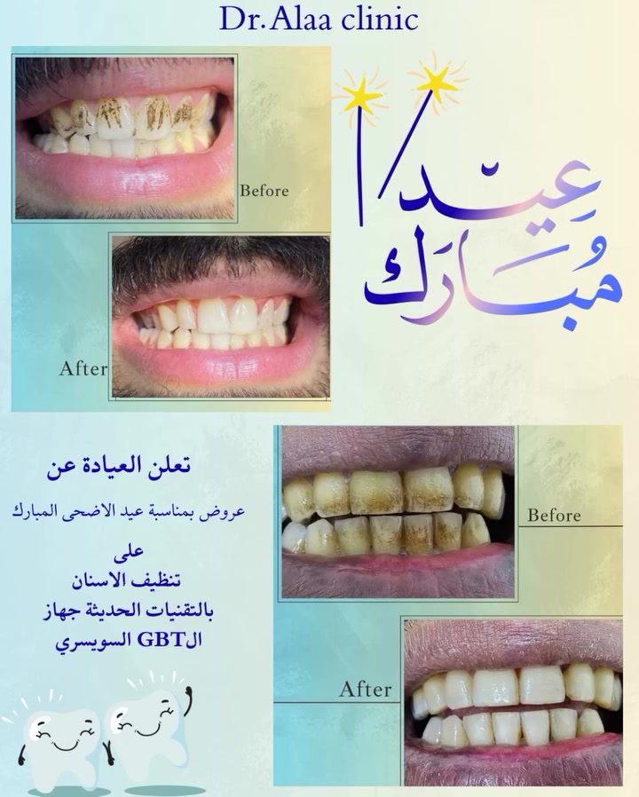 ✨تعلن عيادتنا عن **عروض تنظيف الاسنان **
بأحدث  التقنيات جهاز الGBT السويسري
بمناسة عيد الاضحى المبارك🎊
ڪُل عام وانتم بخير ✨ 
للحجز والاستفسار مراسلة الصفحة او الاتصال عبر الرقم : ***********
