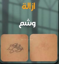 البصرة • إزالة وشوم • أجهزة حديثة