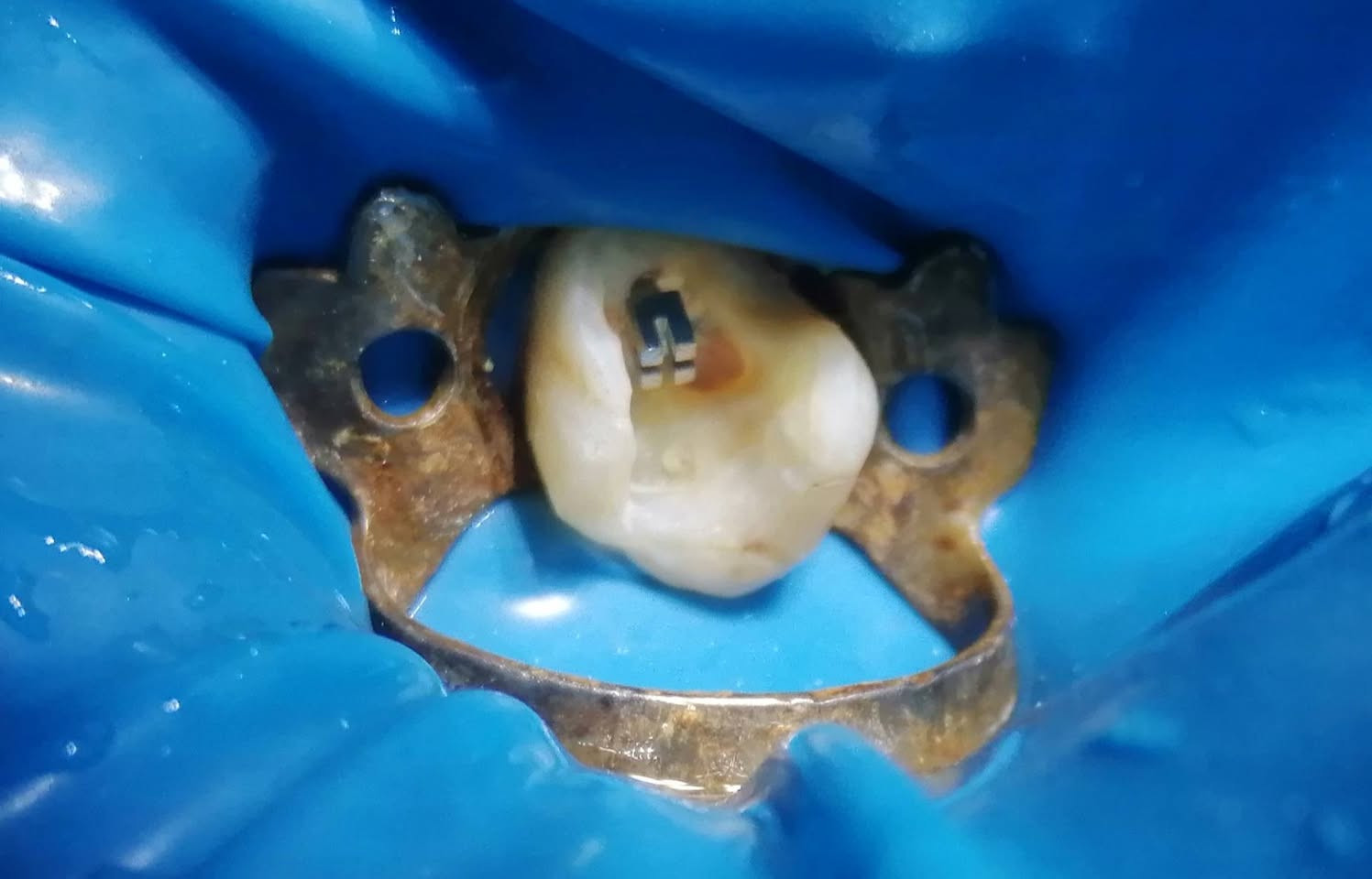 حشوه تجميليه للضرس السادس العلوي الأيمن باستخدام العازل و إضافة برغي تقويه داخل السن وأعادته للوضيفه..
د مهند عبد الجواد الطحان الهاشمي #القياره #مقابل باب طوارئ مستشفئ#القياره مجاور صيدليه عبدالله المعماري للحجز والاستفسار التواصل على الرقم ***********# طابق ارضى.
