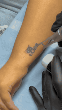 كركوك • تاتو • إزالة وشم