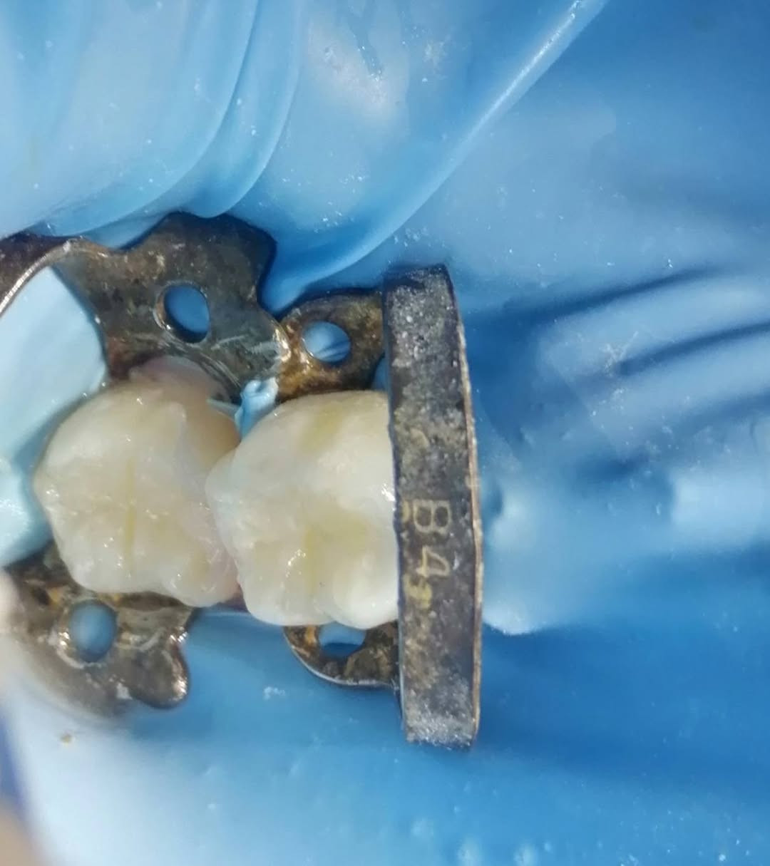 حشوه تجميليه للضرس السادس والسابع السفلي باستخدام العازل المطاطي.
د مهند عبد الجواد الطحان الهاشمي
ماجستير ودبلوم عالي تعويض الأسنان
سايدين مستشفى#القيارهالعام
مقابل باب الطوارى الرئيسي
مجاور صيدليه عبدالله المعماري
للحجز والاستفسار التواصل على الرقم ***********#
طابق ارضى
