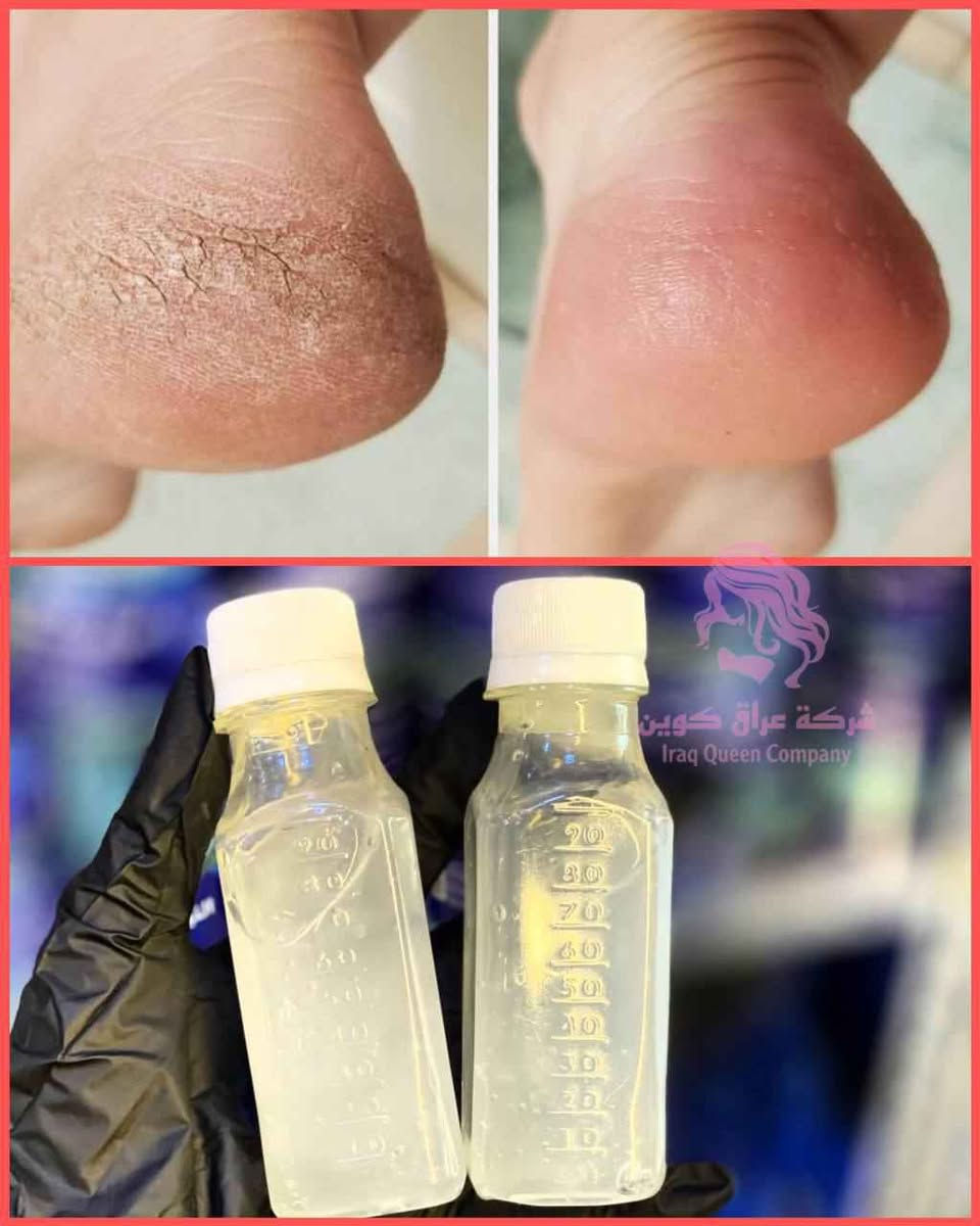 كالوس لازالة الجلد الميت و تشققات القدم
CALLUS REMOVER
ميحتاج تروحين مركز تجميل او صالون توفر منتج ( كالوس ) للقدم تگدرين تشتغليه بالبيت وبكل سهوله ♥️
وضيفته يشيل الجلد الخشن الي بالكعب خلال دقائق 👍✋
مزيل مسامير القدم - قولي وداعًا لتصلب الجلد والجلد الميت. مثل امتلاك باديكير احترافي بدون تكلفة عالية.
القضاء على الناجم في المنزل! - مزيل الجلد الميت هذا للقدمين يعمل خلال 3 إلى 5 دقائق! ببساطة انقع قدميك في حوض الاستحمام أو في حوض قدم، انتظر ثم استخدم أداة تنظيف القدم المفضلة لديك أو حجر خفاف القدم لإزالة مسامير القدم بلطف.
استخدمه مع مقشِّر قدمك المفضل - لا يقتصر على إزالة مسامير القدم فحسب، بل يجعل قدميك ناعمتين وناعمتين للطفل.

كالوس تقشير اقدام  فوري وفعلي للاقدام 
  طريقة الاستخدام:
   تغسل الاقدام بالماء  والصابون وتنقع في ماء ساخن. لمدة 5 دقائق  ومن  ثم تجفف  وتوضع قطرات من الكالوس على الجلد الخشن والتشققات وتدلك بواسطة شريحة قطنية وتترك لمدة 3 دقائق فقط وبعدها يستعمل   حجر او مبرد لازالة الجلد الميت ملاحظة يفضل استخدام قفازات بلاستيكية اثناء الاستخدام
المنشأ اماراتي اصلي 💯   
🚘 يوجد خدمة توصيل لجميع محافضات العراق بغداد, العراق


**إذا كنت صاحب هذا الإعلان وتريد حذفه لأي سبب، رجاءا أرسل رسالة إلى الدعم الفني**