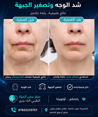 شد الوجه • تصغير الجبين • الناصرية