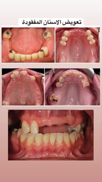 طقم جزئي • قلع اسنان • حشوات بيضاء