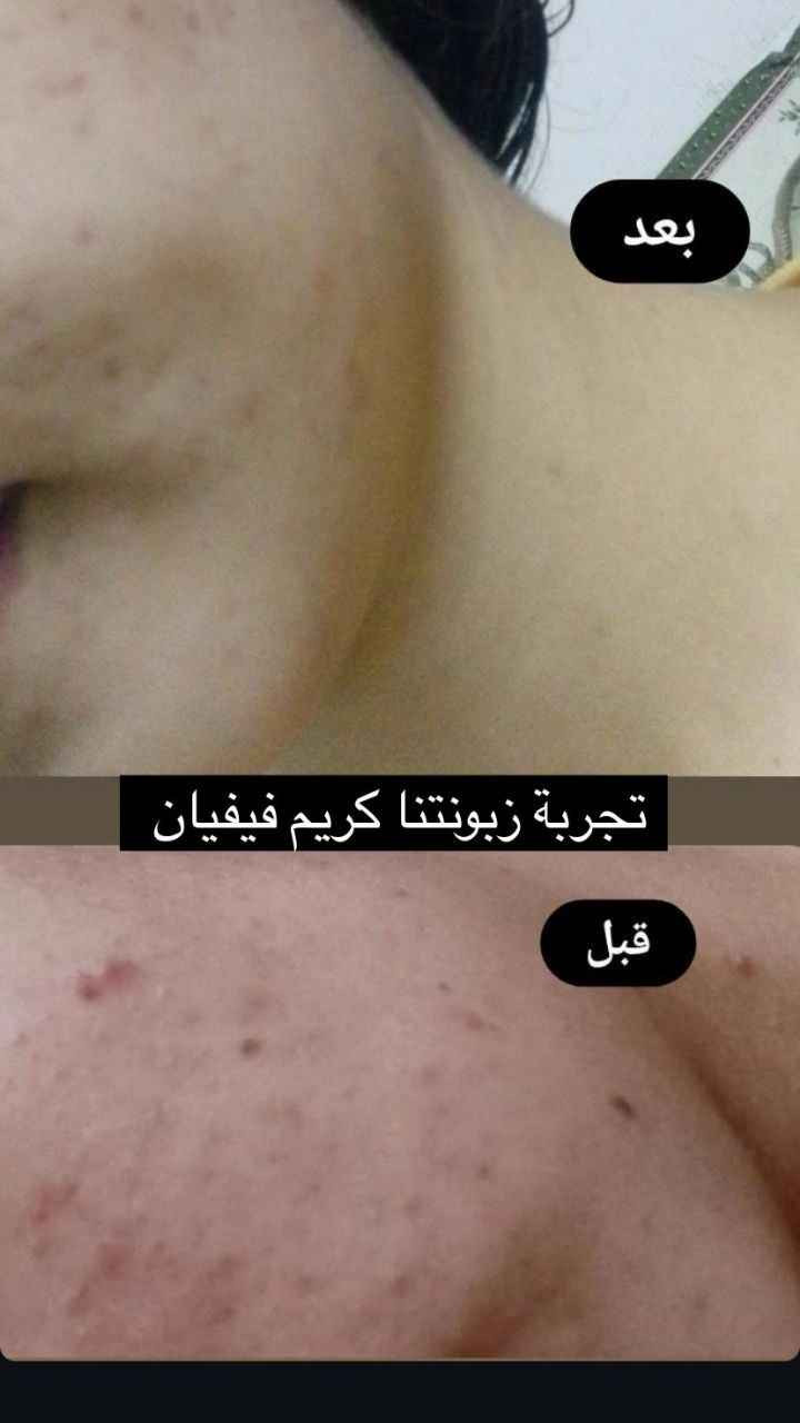 ❄️ احد اهم افضل المنتجات لتبييض البشرة ❄️
.
🟢كريم فيفيان مصنوع من 14 مادة عشبية 🍀 و6 فيتامينات  💊
.
 🎗منتج واحد يساعد علئ حل اهم 5  مشاكل للبشرة 🎗
.
يبيض البشرة - يعالج الكلف - يعالج التصبغات - يعالج الهالات التحت العين - يرطب البشرة وتصبح اكثر نضارة 
.
كريم فيفيان منتج ®️ صنع في كوريا ويعمل بسياسة 🎗 ما بعد البيع كـ  🔁 الاستبدال والاسترجاع  
.
نتيجة الكريم ثابتة ودائمية 🟢 نتائج حقيقية من اول  استخدام 🟢 بدون اثار جانبية اثناء  او بعد ترك الاستخدام  بسبب التركيبة العشبية

👈🏻💌اي استفسار او الحجز👇🏻
 ***********

#التوصيل_لجميع_المحافظات بغداد, العراق
