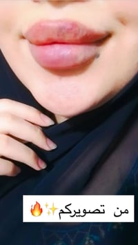 فلر شفة • تعديل حقن • الكوت الهورة