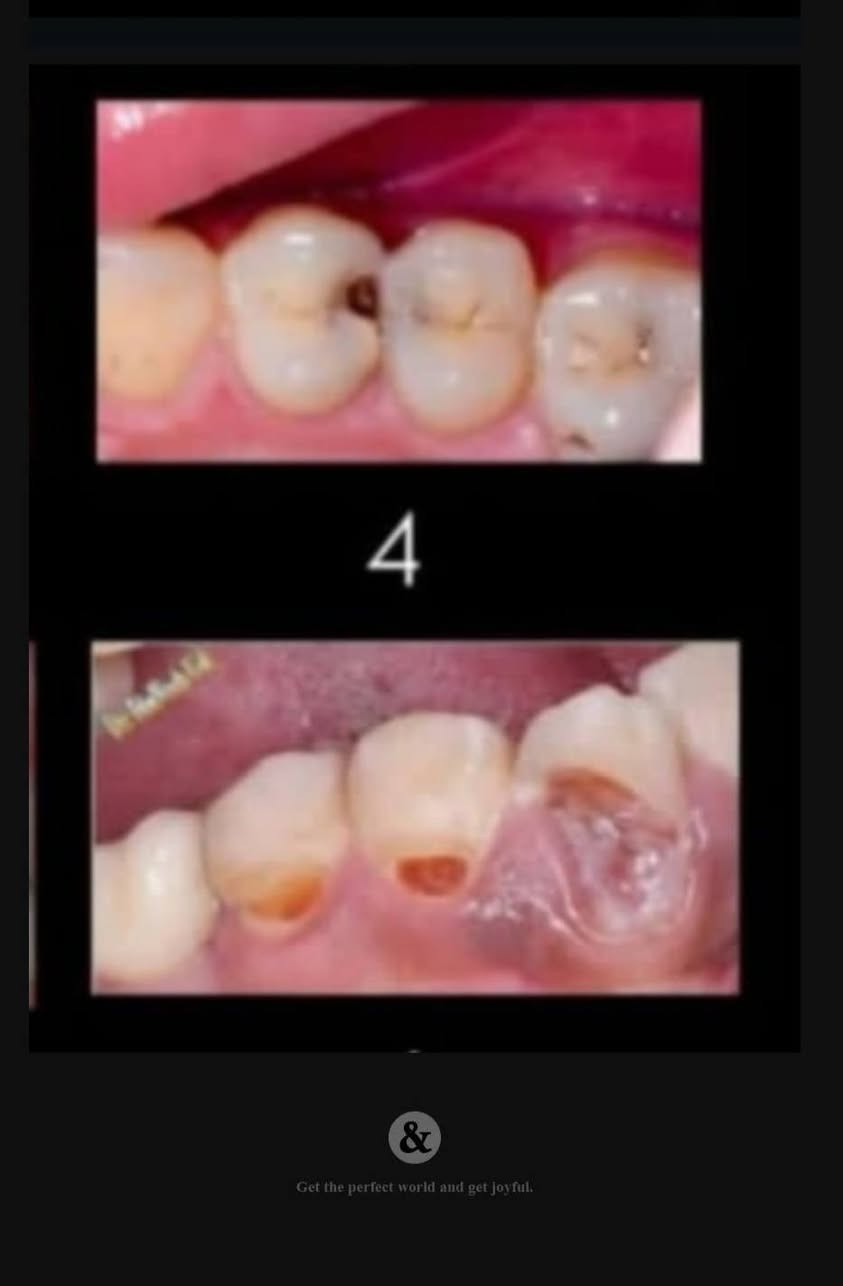 السلام عليكم
الي محتاج حشوات تجميلية +قلع +تنظيف الأسنان من تكلسات 
للحجز ***********
عيادات بيارق العميد السعدية خلف مول الحارث 
العمل مجاني بلكامل
