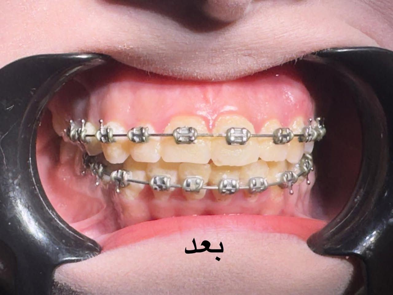 رفع التقويم بعد ترتيب وتعديل الاسنان للفكين
طبيب الاسنان الاختصاص د.عمار عباس
ماجستير تقويم وتجميل الاسنان M.S.c ortho
بكلوريوس طب وجراحة الفم والأسنان B.D.S
بغداد الشعب شارع عدن قرب  مركز شرطة الشعب  مدخل سوق شلال عمارة باريس الطابق الاول دوام العيادة جميع ايام الاسبوع ما عدا الجمعة عطلة من ٤ ل ٨  بدون حجز مسبق الدخول حسب اسبقية الحضور للعيادة الفحص والمعاينة مجاني للاستفسار ***********
