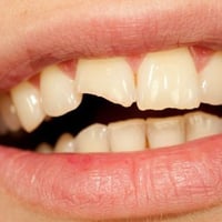 مجاناً،، منو عنده كسر بل سن الأمامي، حشوات تجميليه و اعادة السن الى شك...