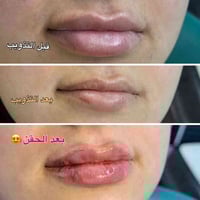 إذابة فلر • متكتل شارب • المسيب