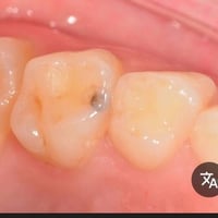 الي عنده تسوس بين الاسنان المجاورة وراد يعالجها حشوة ضوئية تجميلية بسع...