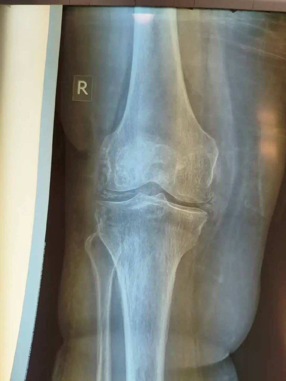 مريضة كبيرة بالعمر تعاني من مشاكل في الكلى حضرت وهي تشكو من: 
▪️ ألم شديد جدًا في الركبة
▪️ صعوبة بالحركة
▪️ عدم القدرة على المشي من شدة الألم
🔍 الأشعة بيّنت وجود ترسّبات كلسية داخل المفصل وهاي الحالة تُسمّى (النقرس الكاذب) وتختلف عن النقرس المعروف، لكنها ممكن تكون أشد ألمًا خصوصًا عند كبار السن.
💉 العلاج كان:
 ▪️ إبرة كورتزون داخل المفصل لتخفيف الالتهاب بسرعة
▪️ علاجات فموية مناسبة مع مراعاة وضع الكلى
✅ الحمدالله تحسّن واضح بالألم بعد العلاج
⚠️ ملاحظة مهمة:
كبار السن ومرضى الكلى يحتاجون علاج دقيق ومحسوب
والمسكنات العشوائية ممكن تضر أكثر مما تفيد.

الدكتــــــــور أحمد عباس الهلالي
دكتـــــــــوراه بورد في أمراض المفاصل والروماتيزم والمناعة الذاتية والإصابات الرياضية
📍 السماوة – شارع العيادة الشعبية ـ عگد الجامع – خلف صيدلية اللؤلؤة – قرب رضا عويز
📞 رقم الحجز: ***********
🔗 رابط الحجز الإلكتروني:

https://aullan.com/d/hilali
