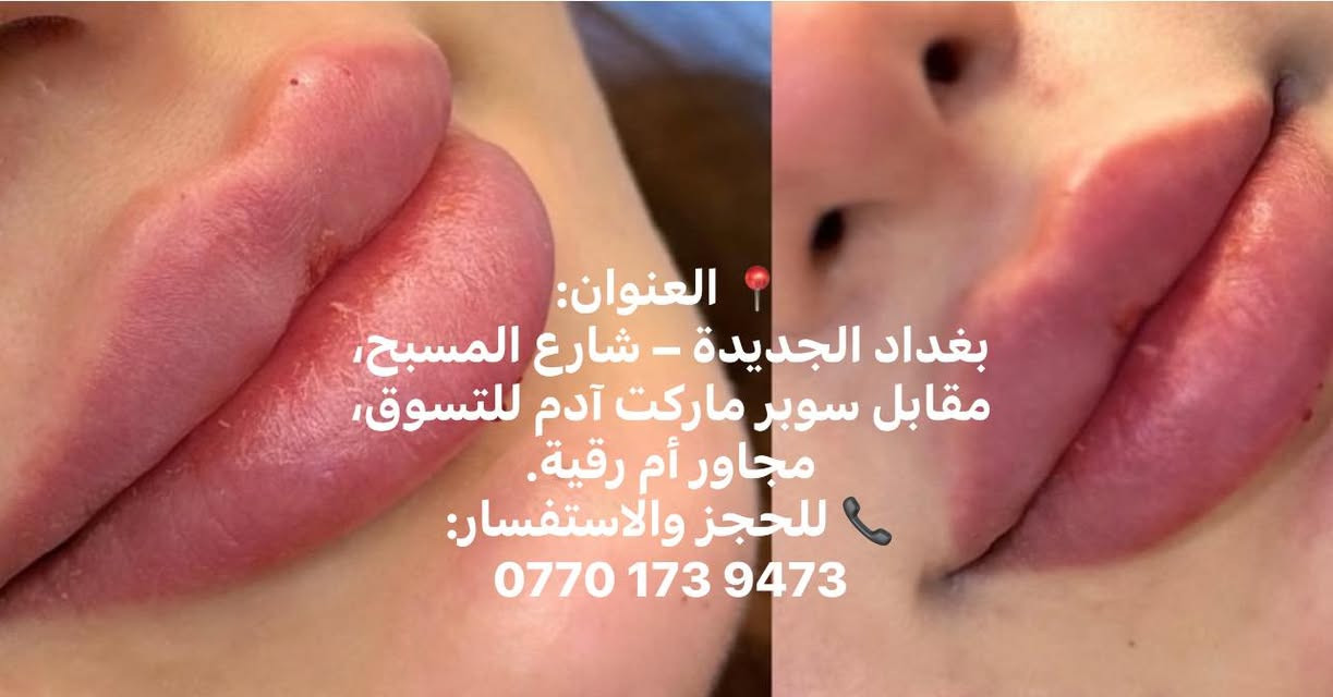 📍 العنوان:
بغداد الجديدة – شارع المسبح، مقابل سوبر ماركت آدم للتسوق، مجاور أم رقية.
📞 للحجز والاستفسار:
***********

