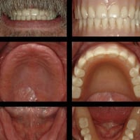 طقم اسنان • تركيب اسنان • البصرة الجبيلة