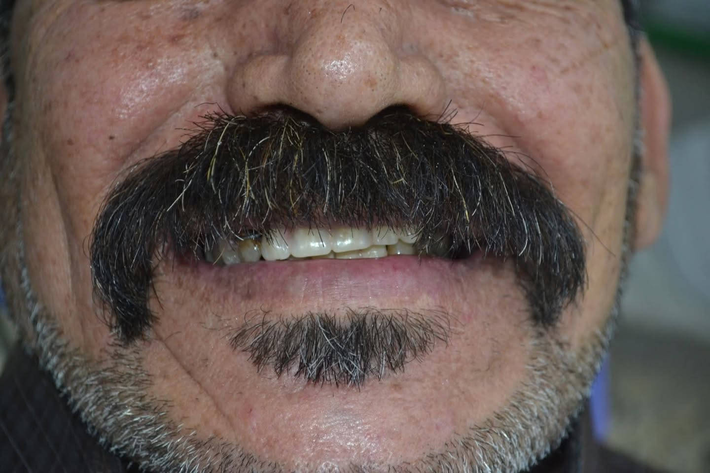 مسابقه -مسابقه- مسابقه 

الكثر شخص متفاعل بعيادتنا يفوز ويانا
شروط المسابقه كلش سهله

1-لايك
2-اكثر شخص يسوي تاكات للاصدقاء
ومتفاعل بلحساب
3-مشاركت المنشور باكثر م̷ـــِْن كروب
4-متابعة الحساب 

الجوائز 🎁🎁🎁🎁

1-تنظيف vip
2-تقويم اسنان
3-تغليف اسنان زاركون 
4-حشوة تجميلية

يتم علان الفائز اول يوم العيد 

المكان/ حي 17 الشارع العام لمكتبة المهندس مجاور لمدرسة المشاعل
للحجز والاستفسار/ ***********

هاي الحاله طقم اسنان متحرك في عيادتنا لمراجع كان يعاني من تقدم في الفك الاسفل ومشاكل في الأطباق 
وهاية النتيجة النهائية بعد تصحيح الاطباق 🔥
