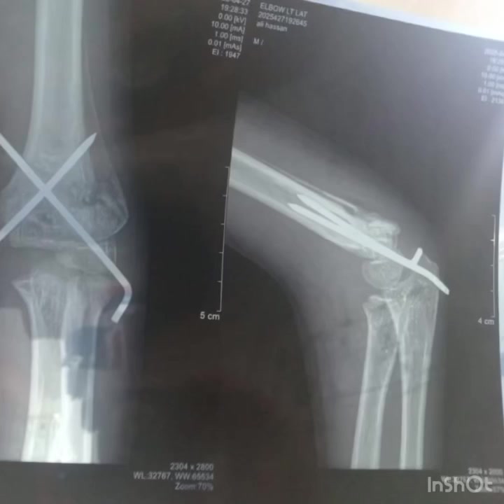 🌟 نجاح مميز في علاج كسور الأطفال 🌟

تم بحمد الله إجراء عملية ناجحة لطفل بعمر 8 سنوات كان يعاني من كسر في مفصل المرفق، حيث تم تثبيت الكسر بالطريقة الحديثة المغلقة دون فتح جراحي كبير، مما ساعد على تقليل الألم وتسريع الشفاء.

والحمد لله بدأ الطفل بتحريك مفصل المرفق في الأسبوع الثالث بعد العملية، وهي نتيجة ممتازة تعكس دقة العلاج والطريقة الجراحية المتقدمة المستخدمة.

👨‍⚕️ إجراء العملية بإشراف:الدكتور إبراهيم علي الفريجياختصاص بورد جراحة العظام والكسورزميل المجلس العراقي للاختصاصات الطبية

📍 العنوان:ديالى / جلولاء / مجمع الدكتور ستار الحربي المتكامل /مقابل مول جكليته 

📞 رقم الحجز والاستفسار:
*********** 

🔹 خبرة في علاج الكسور وإصابات المفاصل للكبار والأطفال🔹 استخدام أحدث الطرق الجراحية لضمان أفضل النتائج وعودة الحركة الطبيعية

**صحتكم أمانة… ونحن هنا لخدمتكم.
