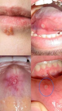 مبادرة مجانية لمعالجة امراض الفم من تقرحات والالام في الفك اثناء الكلا...