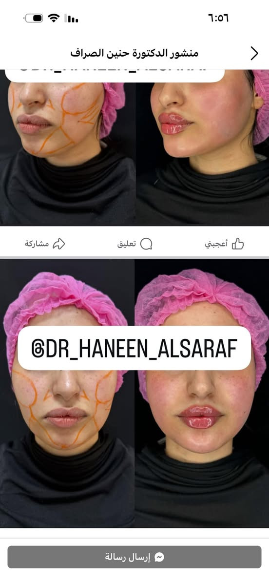 هذا ابدااع الدكتورة حنين الصراف في التجميل في الفلر والبوتوكس والخطوط الضاحكة … شكرا لطبيبة التجميل العراقية بنت 
الكوت


**إذا كنت صاحب هذا الإعلان وتريد حذفه لأي سبب، رجاءا أرسل رسالة إلى الدعم الفني**