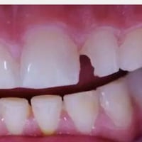 اللي عندة مثل الصورة ويريد نسويلة حشوة ضوئية مجاني يتواصل واتساب 07849...