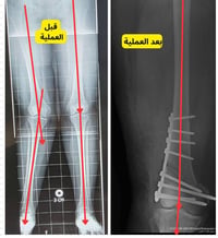 تعديل انحراف الساق • د.مثنى سالم • جلولاء