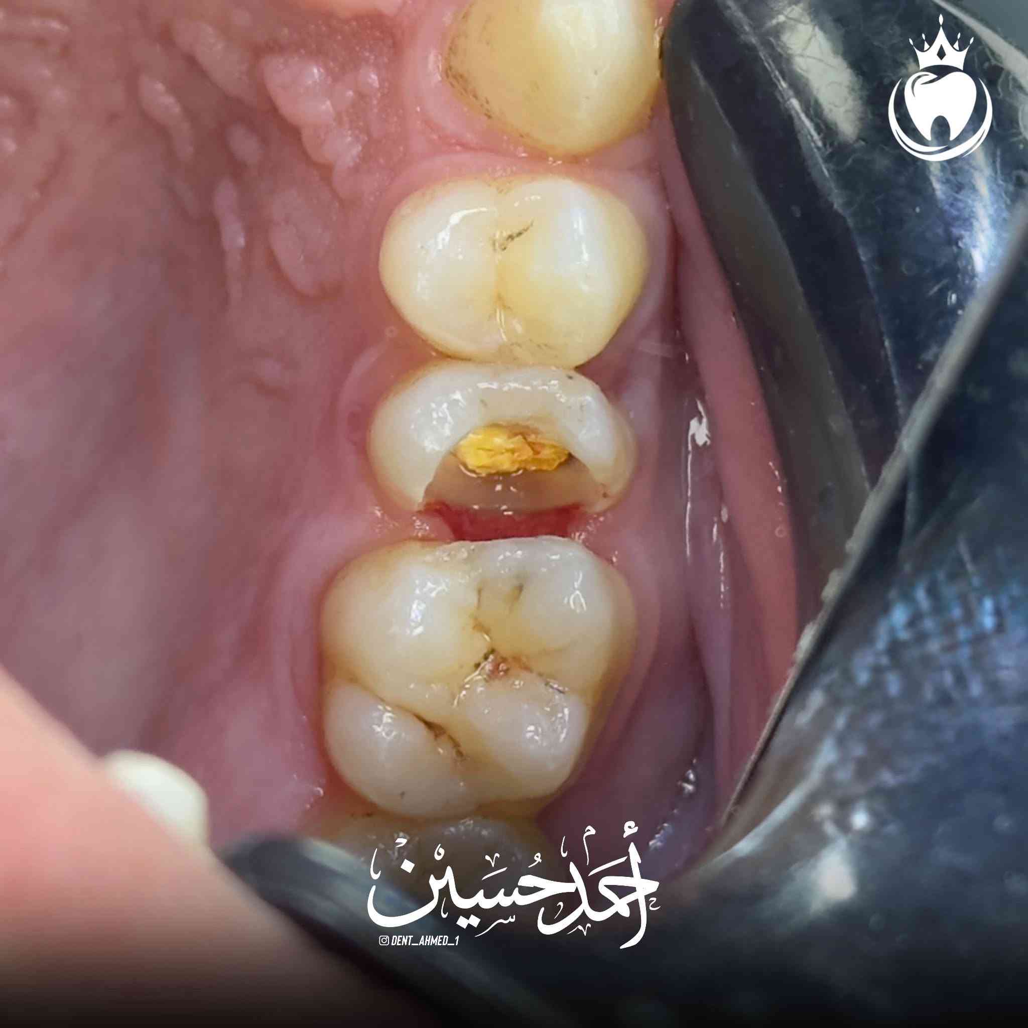 و كالعادة مراجعنا يشكو من الم مستمر في السن الضاحك العلوي و العلاج حشوة جذر مع حشوة تجميلية و اختفاء الالم و لله الحمد

الدكتور أحمد حسين الطعماوي 
المجمع الطبي الحديث مجاور مرطبات كرزة
التواجد جميع ايام الاسبوع بعد صلاة العصر الى الساعة ٨:٠٠ مساءََ
للحجز و الاستفسار :***********
