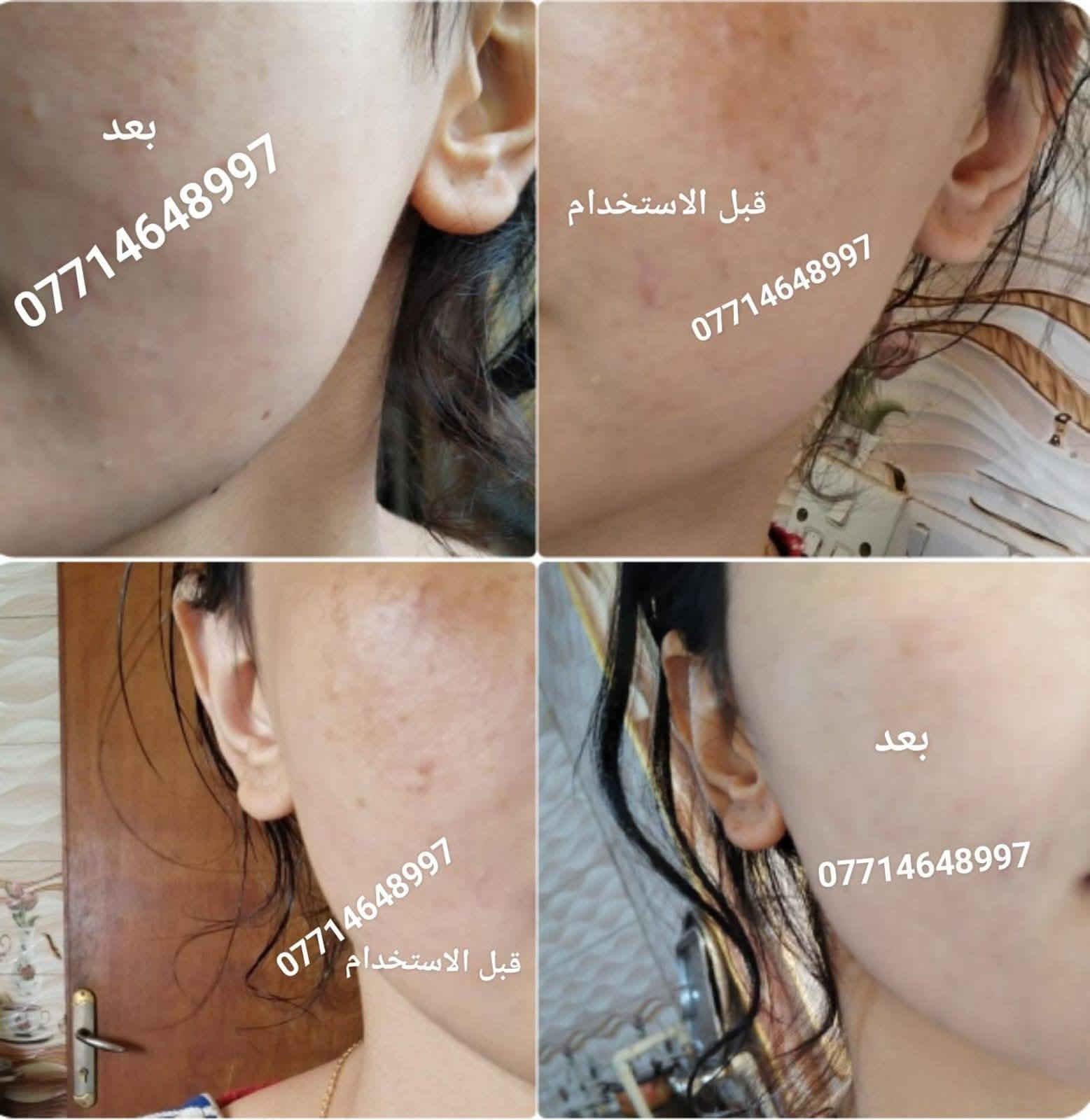 🙏انتبااااااااااه 🙏  الحجز فقط (وتساااااب ) علا اوليفيرا  ***********77
الي يعانوون من جميع مشاكل البشره مع منتجاتنا الطبيعيه  تمتعي ببياض الثلج 😍
 معالج الفااوربتين و السيراميد والعنبر وسيروم الباكشويل وسيىوم النضاره بكج متكامل 
تفتح البشرة 7 درجات والنتيجة دائمية 👌 وهذي تجارب زبائني تشهد 
خدمه توصيل لجميع محافضات
