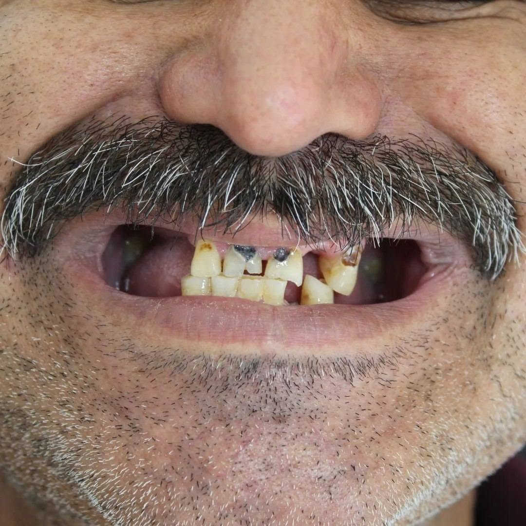 🦷 ابتسامة  بتصميم طبيعي، لون متناسق، ونتيجة تعزز الثقة بكل ابتسامة.
إذا كنت تبحث عن ابتسامة مرتبة وطبيعية تناسب ملامحك، فهذا هو الوقت المناسب.
زوروا عيادتنا
الامين الثانيه /النواب/شارع المهداوي مقابل عيادة النبأ

📩 للحجز والاستفسار راسلونا على ***********، والمواعيد محدودة.
