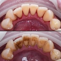 اللي محتاج قلع بقايا الجذور او تعويض بطقم متحرك للاسنان المفقودة او حش...