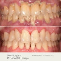 تنظيف اسنان • تكلسات قوية • علاج مجاني