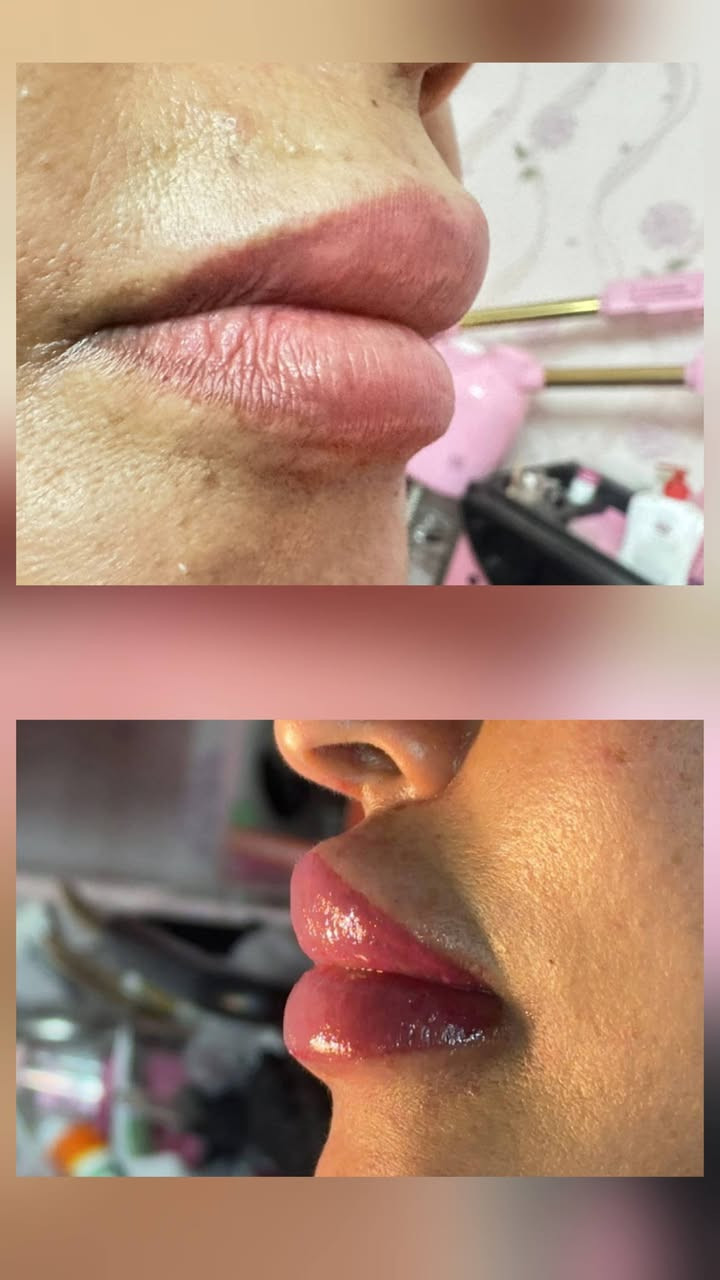 #جلسة_تانية_توريد_شفاف👄
أحلى و أقوى قرار رح تاخديه قبل العيد هوي توريد الشفاف ❤️
لانو العيد أحلى لما تختاري نفسك 🌸
النتيجة رح تكون شفايف وردية ، ثقة أعلى ، وراحة كل يوم بدون ماكياج 😍
للحجز تواصل عالدايركت او عالواتسآب ***********📲
