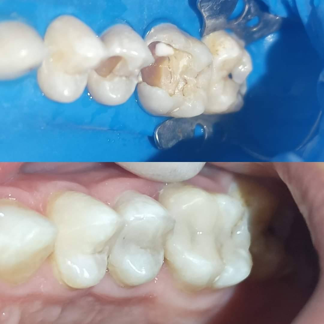 عيادة طب الاسنان الحديثة 
الدكتور علي كاظم رشيد القريشي 
حشوات ضوئية-قلع سن العقل-حشوات جذور
تنظيف و تبييض الاسنان الليزري -تركيب الاسنان الثابتة والمتحركة 
قضاء البدير-شارع الأطباء الطبي(بيت الحاج دريول) خلف مدرسة القاهرة مجاور صيدلية البديرالنموذجيه ***********
عيادة الدكتور علي كاظم القريشي لطب وزراعة وتقويم وتجميل الأسنان @إشارة
