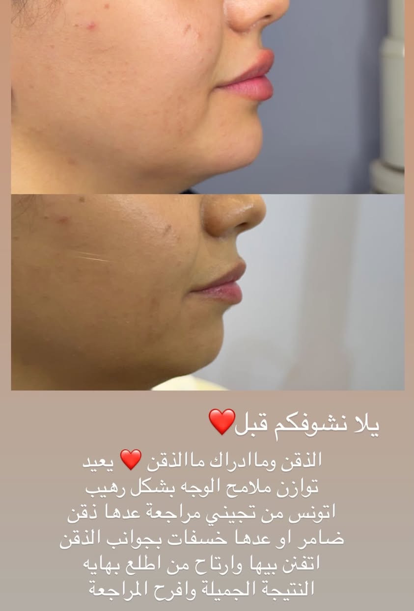 جمال حقن الشفه والذقن واعادة تنسيق ملامح الوجه ❤️🫰🏻

عيادة الدكتورة مروة محمد التميمي

🏥الديوانية العروبة-شارع المتحف-مجاور مطعم كودو كودو
📞رقم الحجز ***********

متوفر نظام التقسيط على الماستر كارد

